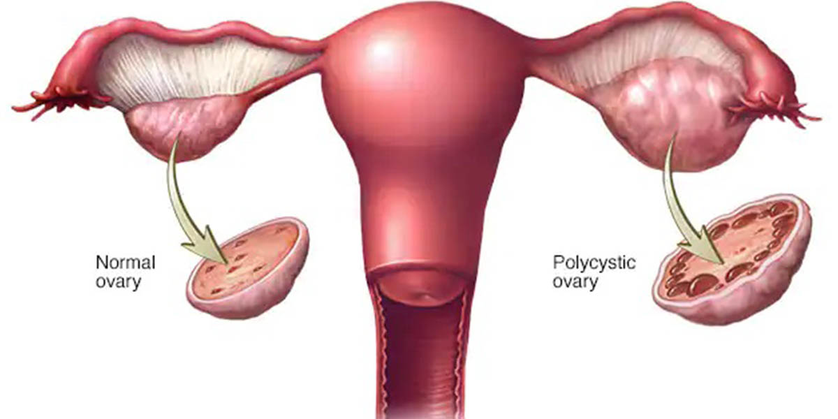 What Is Polycystic Ovary Syndrome