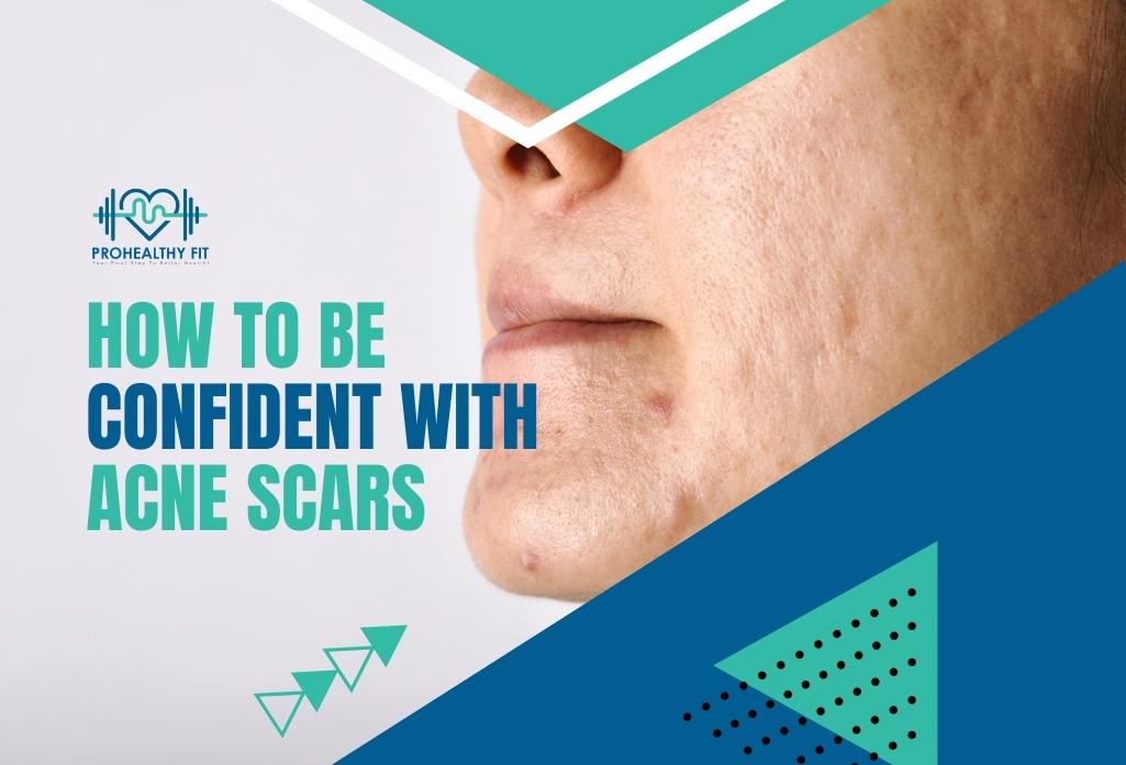 How To Be Confident With Acne Scars