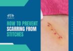 How To Prevent Scarring From Stitches: Best Tips And Prevention