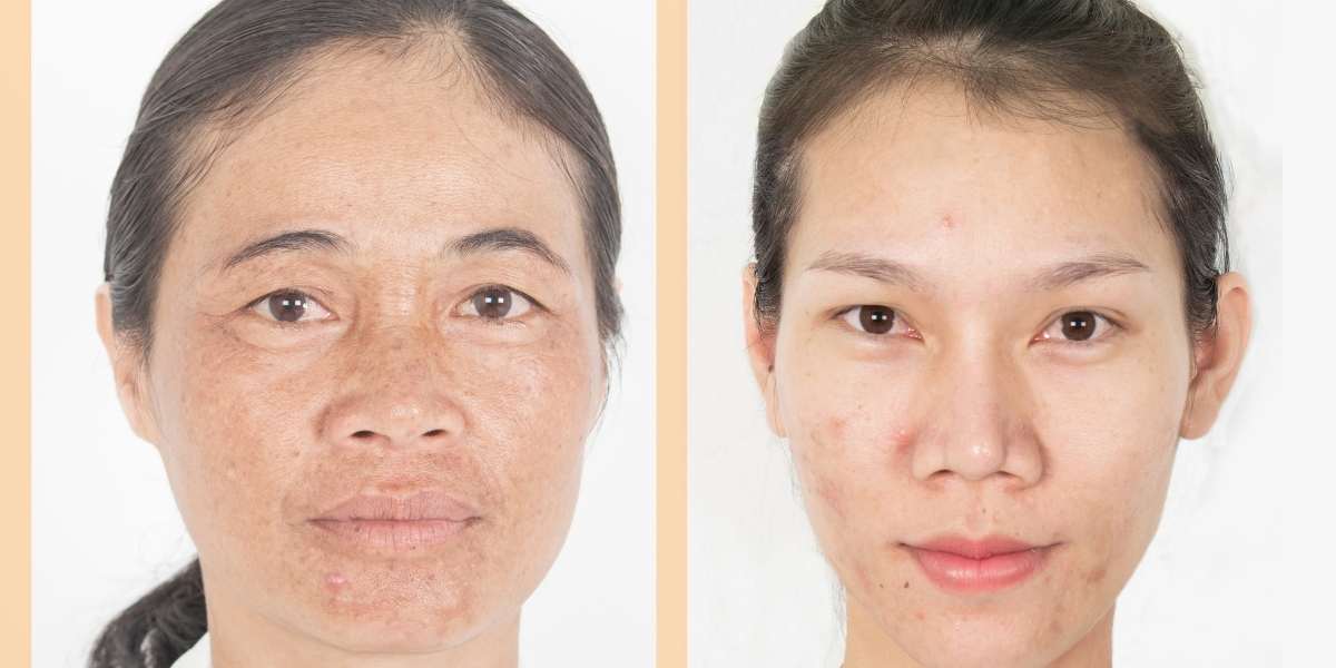 Sun-Spots And Age-Spots